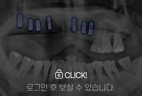 임플란트 전·후