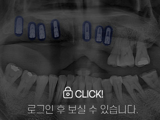 임플란트 전·후