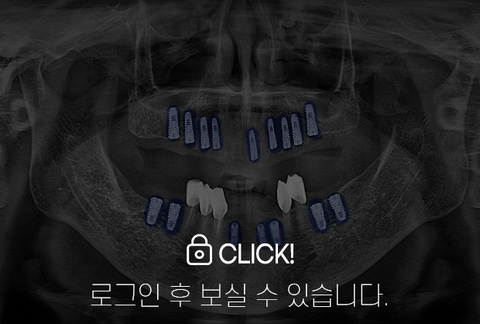 임플란트 전·후