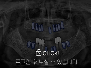 임플란트 전·후