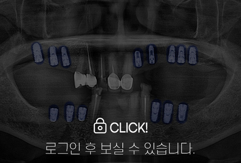 임플란트 전·후