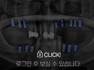 임플란트 전·후