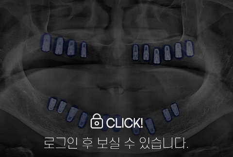 임플란트 전·후