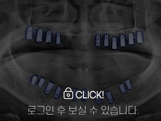 임플란트 전·후