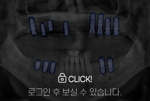 임플란트 전·후