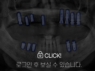 임플란트 전·후
